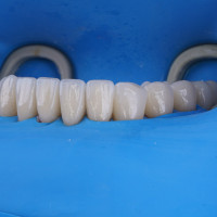 Гид по винирам: как выбрать форму и цвет