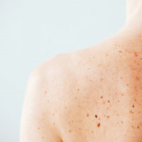 Как убрать пигментные пятна без пилингов и лазерных шлифовок