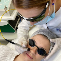 Удаление сосудов лазером KN CRN. Ювелирная работа на лице