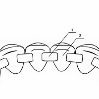Ученые Пермского Политеха и ПГМУ им. академика Е.А. Вагнера разработали конструкцию для лечения пародонтита