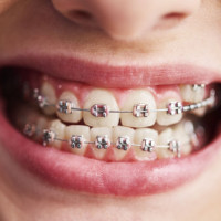 От боли в спине до проблем с желудком: эксперт Пермского Политеха рассказал, чем вредит неправильный прикус